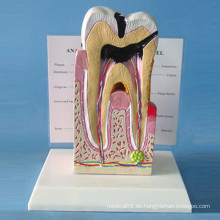 Human Pathological Teeth Anatomie Modell für Demonstration